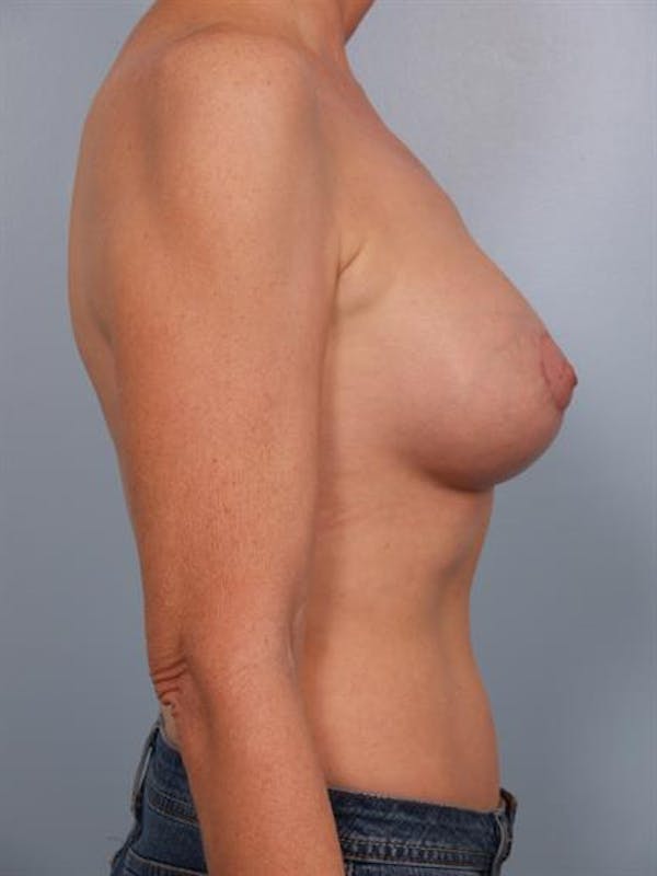 Breast Lift with Implants Before & After Gallery - Patient 1612693 - Image 4