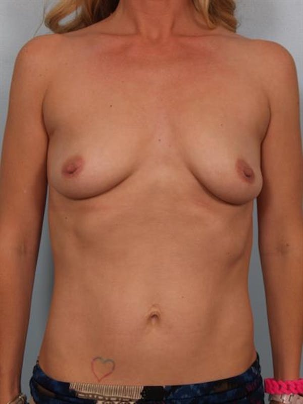 Breast Lift with Implants Before & After Gallery - Patient 1612695 - Image 3