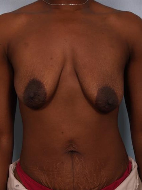 Breast Lift with Implants Before & After Gallery - Patient 1612699 - Image 3