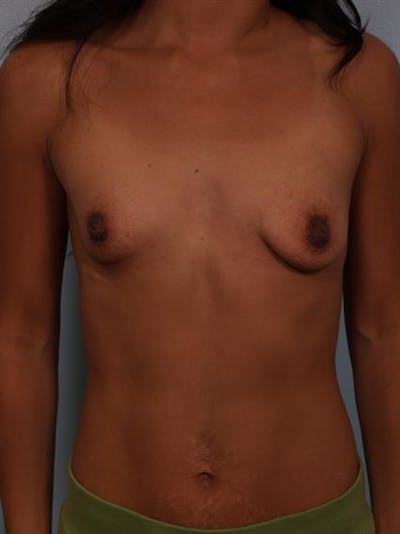 Breast Lift with Implants Gallery - Patient 1612703 - Image 1