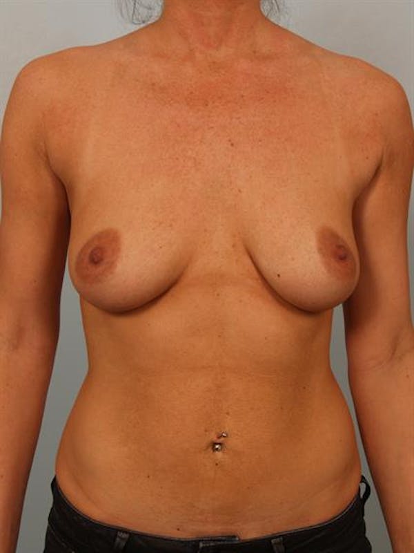 Breast Lift with Implants Before & After Gallery - Patient 1612708 - Image 1