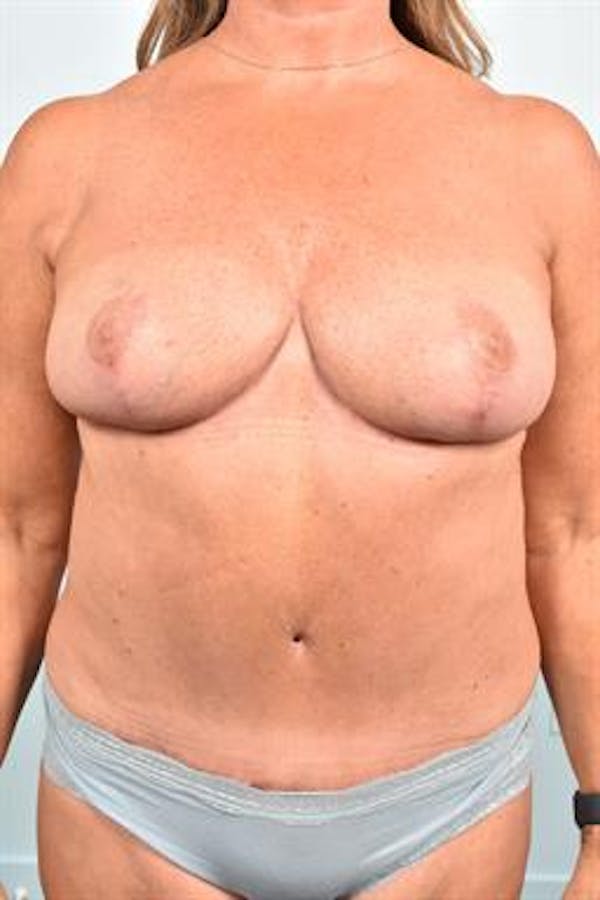 Breast Reduction Before & After Gallery - Patient 347754 - Image 2