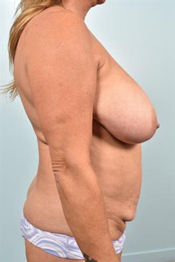 Breast Lift Before & After Gallery - Patient 405107 - Image 5