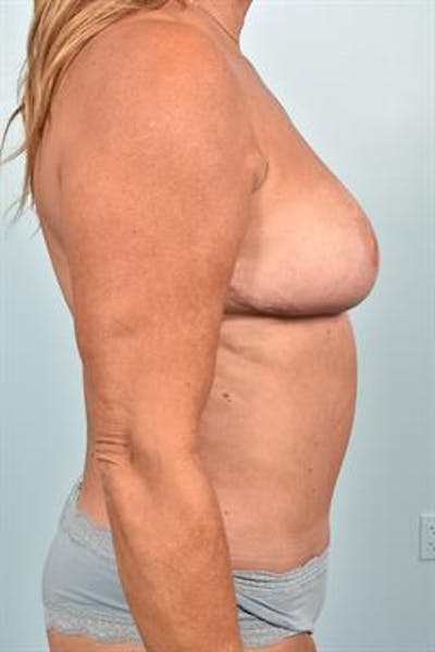 Breast Reduction Before & After Gallery - Patient 347754 - Image 6
