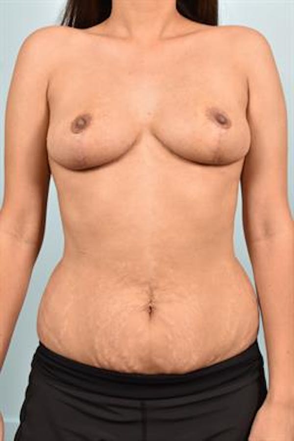 Breast Reduction Before & After Gallery - Patient 109979 - Image 1