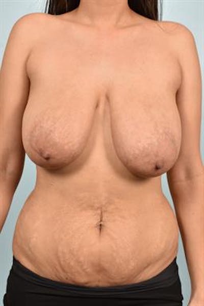 Breast Reduction Before & After Gallery - Patient 109979 - Image 2
