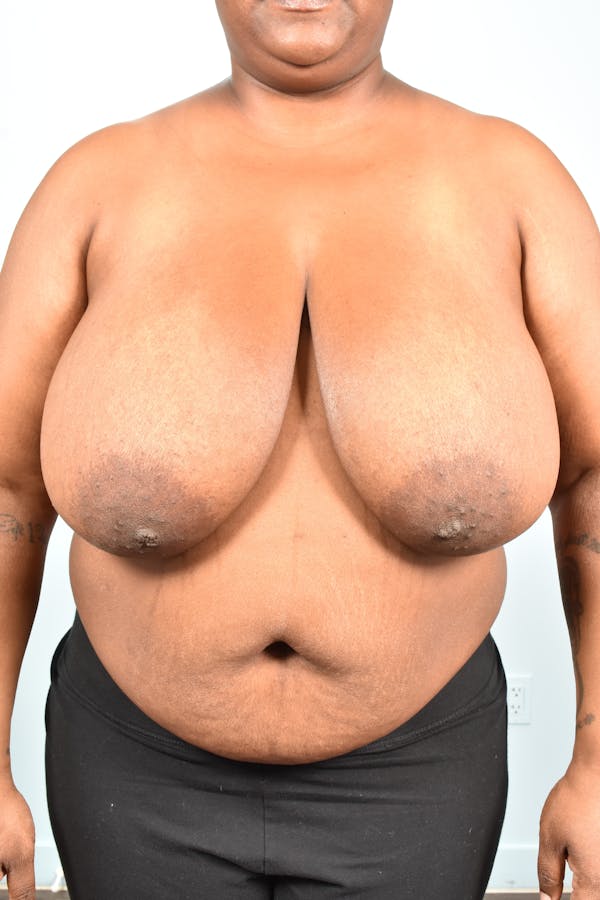 Breast Reduction Before & After Gallery - Patient 331315 - Image 1