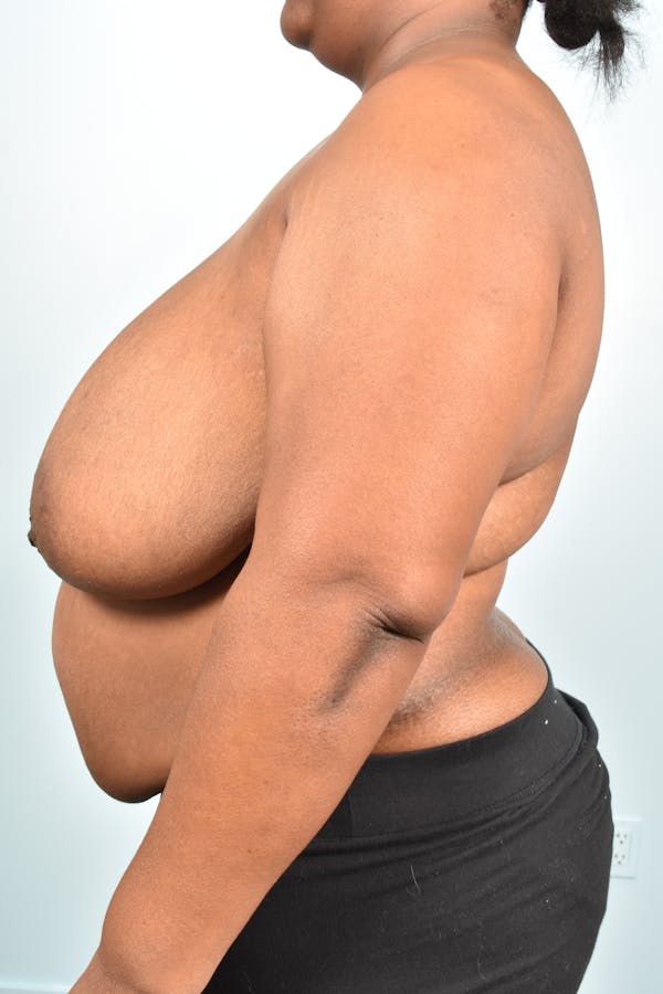 Breast Reduction Before & After Gallery - Patient 331315 - Image 5