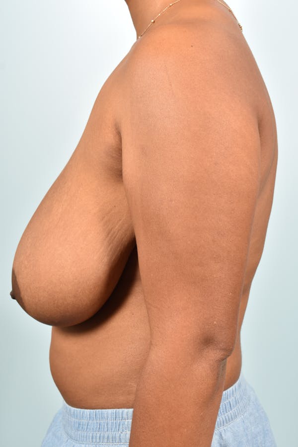 Breast Reduction Before & After Gallery - Patient CeUlVM_LQpGrfHmNC4SENA - Image 5 - by Dr. Cohen in Beverly Hills & Los Angeles