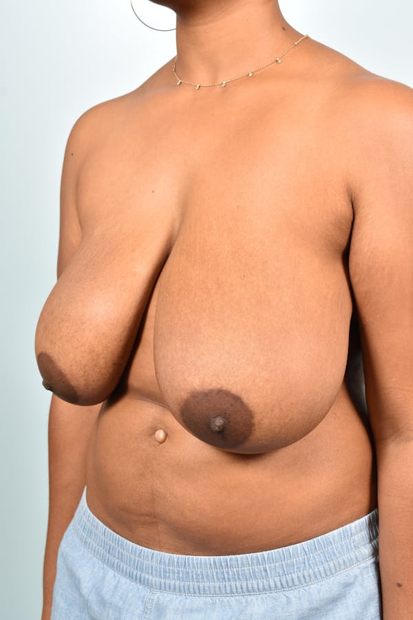 Breast Reduction Before & After Gallery - Patient CeUlVM_LQpGrfHmNC4SENA - Image 3 - by Dr. Cohen in Beverly Hills & Los Angeles