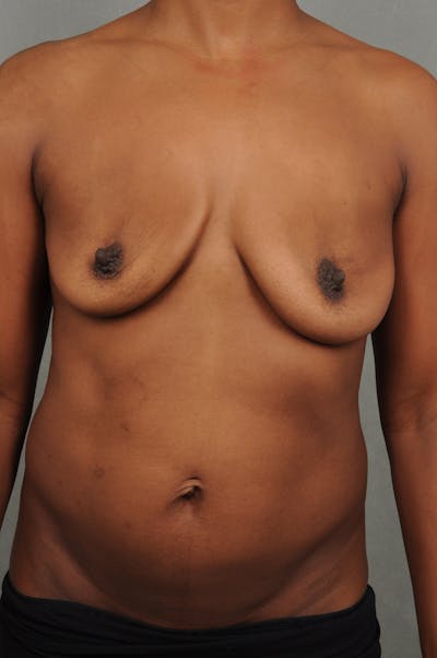 Complex Breast Revision Before & After Gallery - Patient VHty534vRWybZ3na0g1Q7A - Image 2 - by Dr. Cohen in Beverly Hills & Los Angeles