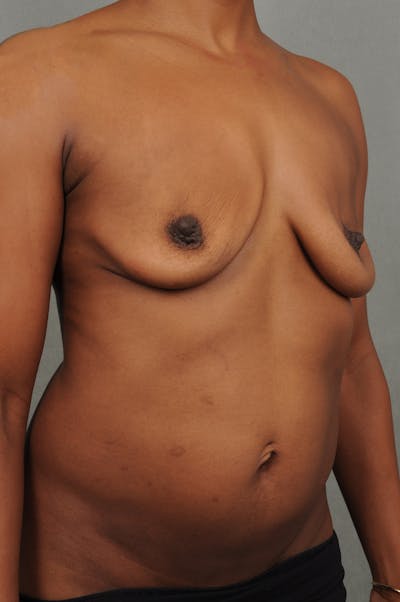 Complex Breast Revision Before & After Gallery - Patient VHty534vRWybZ3na0g1Q7A - Image 6 - by Dr. Cohen in Beverly Hills & Los Angeles