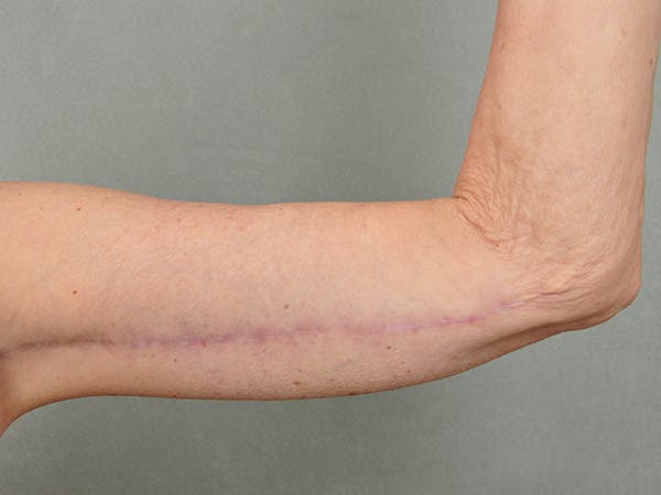 Brachioplasty (Arm Lift) Before & After Gallery - Patient eUFUklp3T2GeWTmR_6qxuQ - Image 2 - by Dr. Cohen in Beverly Hills & Los Angeles
