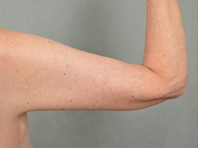 Brachioplasty (Arm Lift) Before & After Gallery - Patient eUFUklp3T2GeWTmR_6qxuQ - Image 1 - by Dr. Cohen in Beverly Hills & Los Angeles