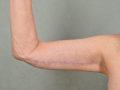 Brachioplasty (Arm Lift) Before & After Gallery - Patient eUFUklp3T2GeWTmR_6qxuQ - Image 4 - by Dr. Cohen in Beverly Hills & Los Angeles