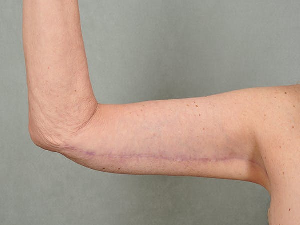 Brachioplasty (Arm Lift) Before & After Gallery - Patient eUFUklp3T2GeWTmR_6qxuQ - Image 4 - by Dr. Cohen in Beverly Hills & Los Angeles