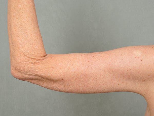 Brachioplasty (Arm Lift) Before & After Gallery - Patient eUFUklp3T2GeWTmR_6qxuQ - Image 3 - by Dr. Cohen in Beverly Hills & Los Angeles