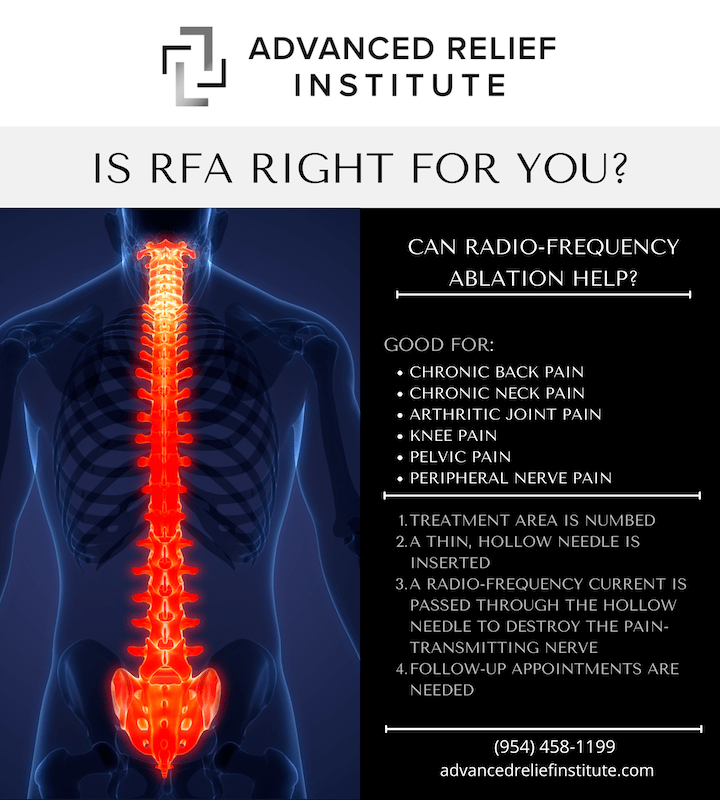 Infographic demonstrating the process of radio-frequency ablation for pain relief
