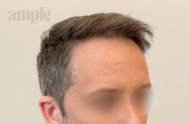 Hair Restoration Before & After Gallery - Patient 175257 - Image 6