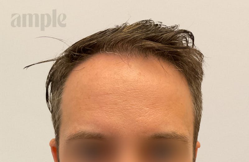Hair Restoration Before & After Gallery - Patient 175257 - Image 3