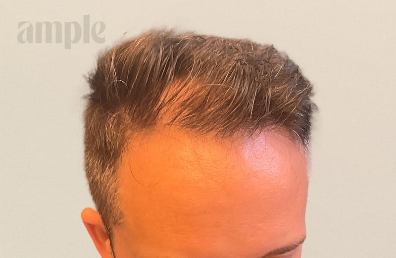 Hair Restoration Before & After Gallery - Patient 175257 - Image 5