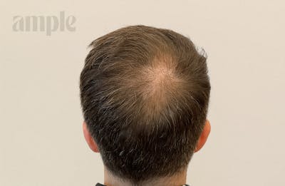 Hair Restoration Before & After Gallery - Patient 175257 - Image 2