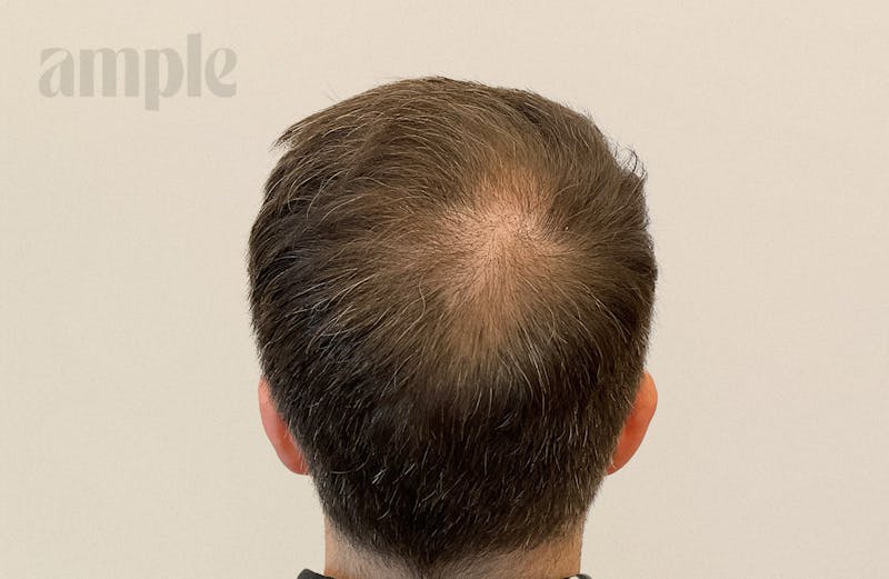 Hair Restoration Before & After Gallery - Patient 175257 - Image 2