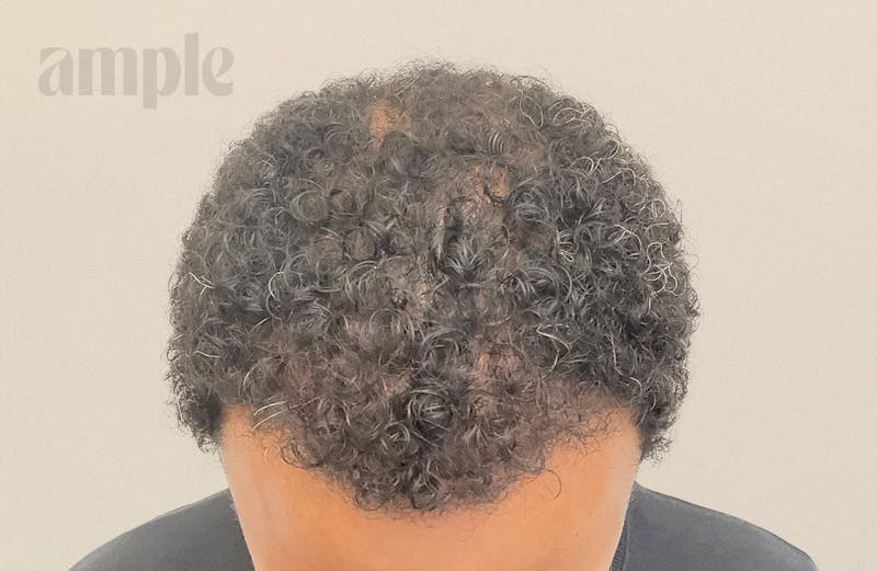 Hair Restoration Before & After Gallery - Patient 387263 - Image 2