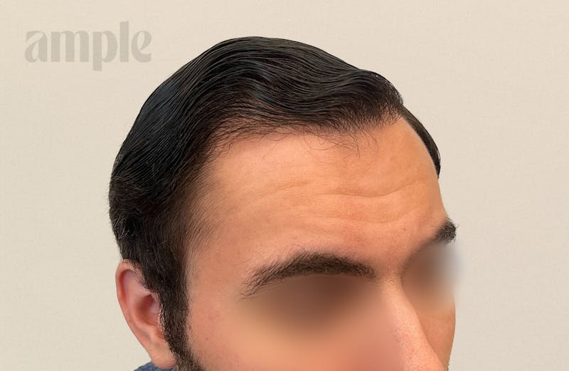 Hair Restoration Before & After Gallery - Patient 896648 - Image 6