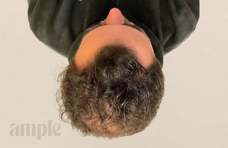 Hair Restoration Before & After Gallery - Patient 896648 - Image 7