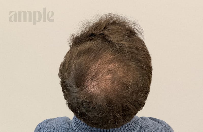 Hair Restoration Before & After Gallery - Patient 896648 - Image 2