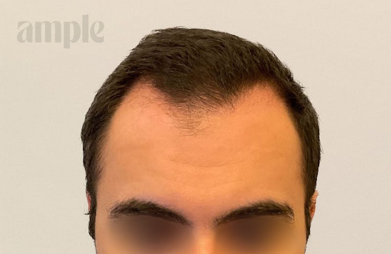 Hair Restoration Before & After Gallery - Patient 896648 - Image 3