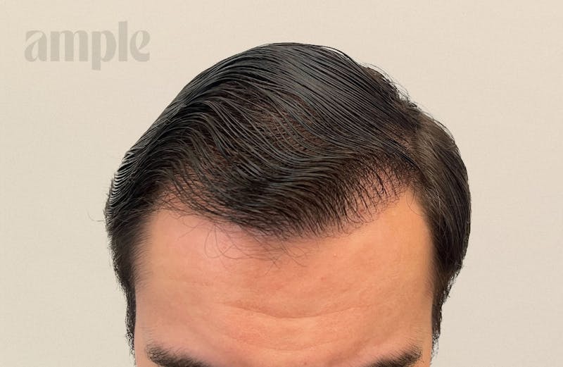 Hair Restoration Before & After Gallery - Patient 896648 - Image 4