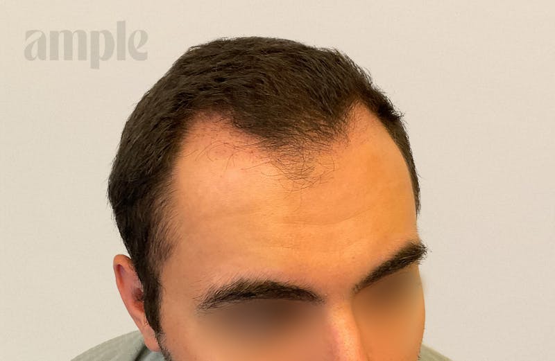 Hair Restoration Before & After Gallery - Patient 896648 - Image 5