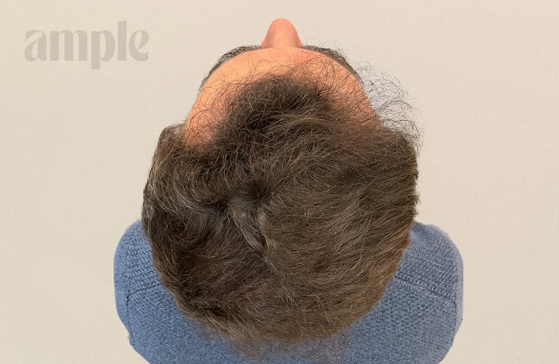 Hair Restoration Before & After Gallery - Patient 896648 - Image 8