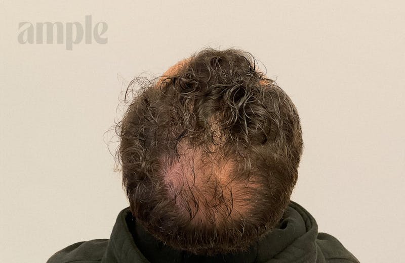 Hair Restoration Before & After Gallery - Patient 896648 - Image 1