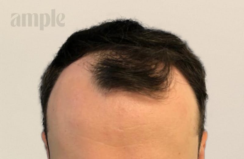 Hair Restoration Before & After Gallery - Patient 400258 - Image 3