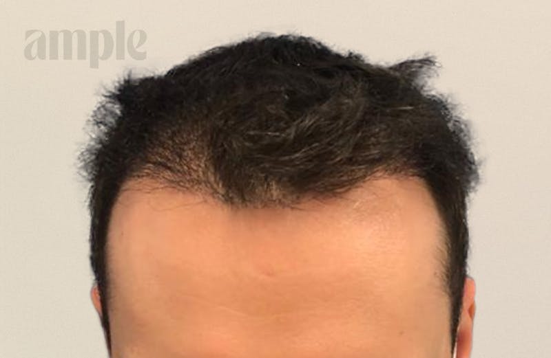 Hair Restoration Before & After Gallery - Patient 400258 - Image 4
