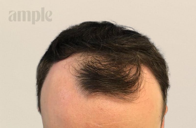 Hair Restoration Before & After Gallery - Patient 400258 - Image 5