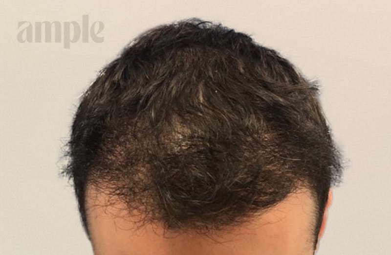Hair Restoration Before & After Gallery - Patient 400258 - Image 6