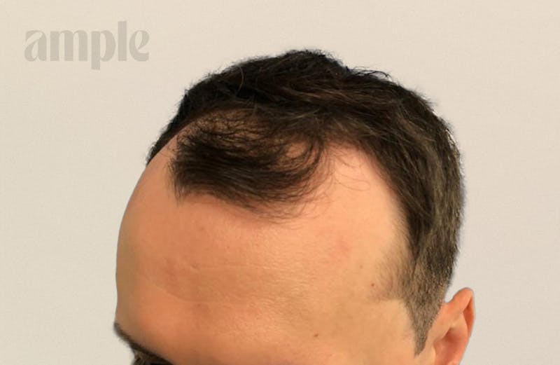 Hair Restoration Before & After Gallery - Patient 400258 - Image 1