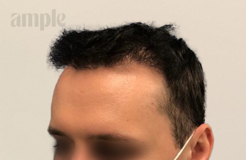 Hair Restoration Before & After Gallery - Patient 400258 - Image 2