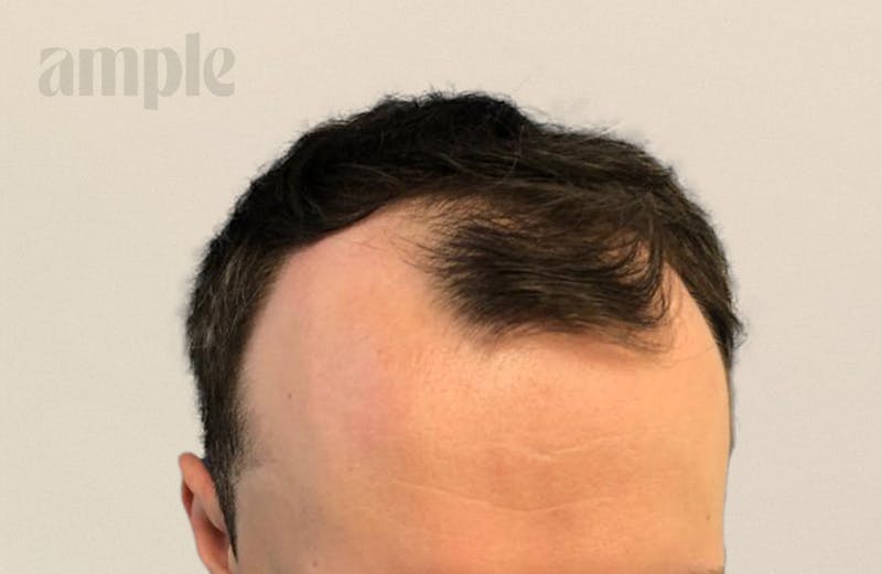 Hair Restoration Before & After Gallery - Patient 400258 - Image 7