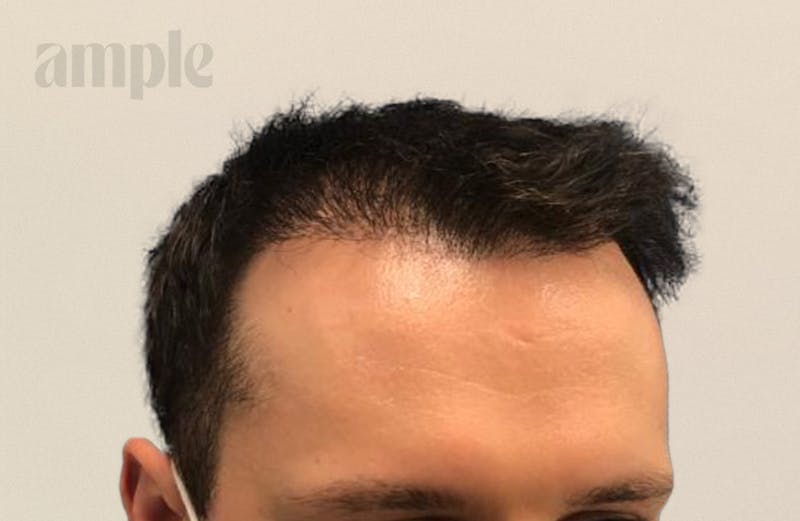 Hair Restoration Before & After Gallery - Patient 400258 - Image 8