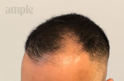 Hair Restoration Before & After Gallery - Patient 228966 - Image 1