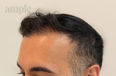 Hair Restoration Before & After Gallery - Patient 228966 - Image 2
