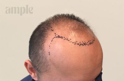 Hair Restoration Before & After Gallery - Patient 310578 - Image 1