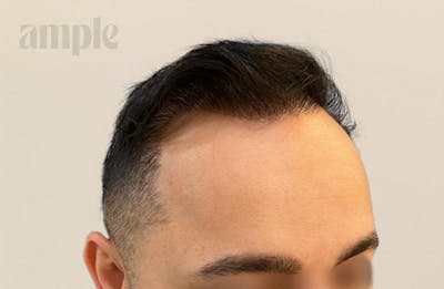 Hair Restoration Before & After Gallery - Patient 310578 - Image 2