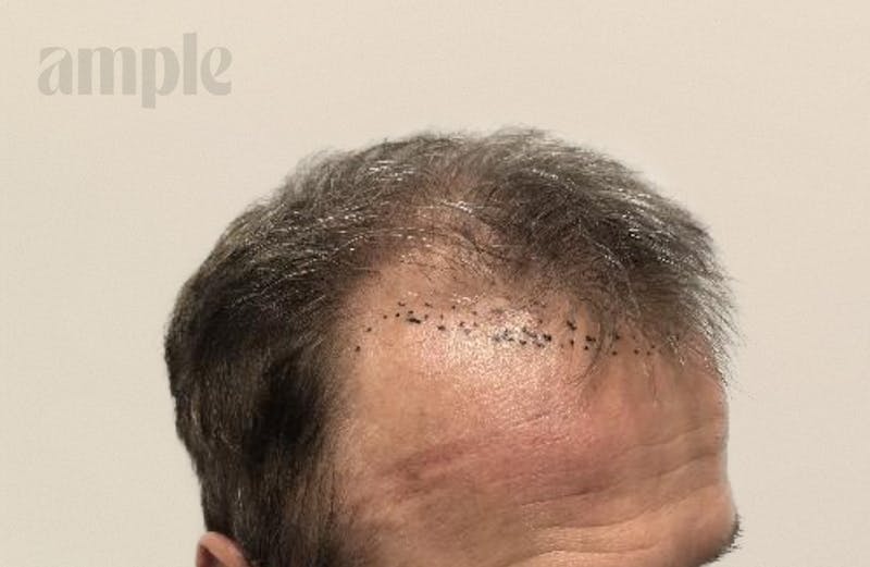 Hair Restoration Before & After Gallery - Patient 394946 - Image 3