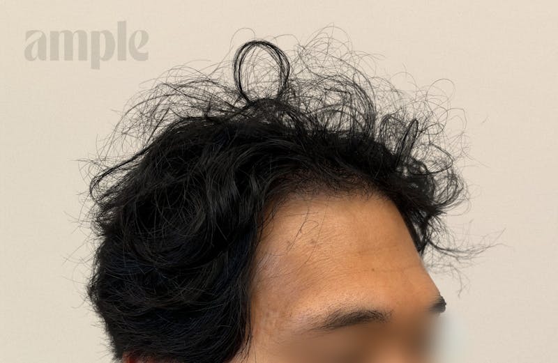 Hair Restoration Before & After Gallery - Patient 103037 - Image 2